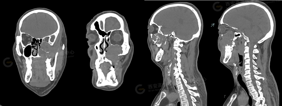 【高尚病例】腺样囊性癌