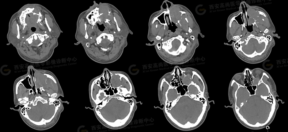 【高尚病例】腺样囊性癌