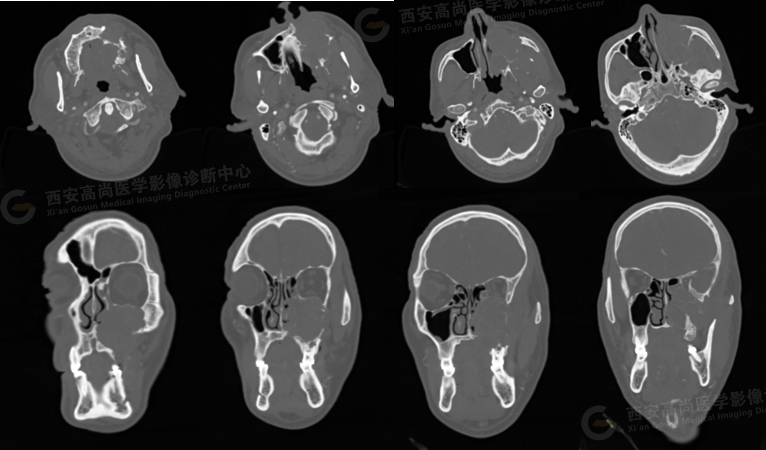 【高尚病例】腺样囊性癌