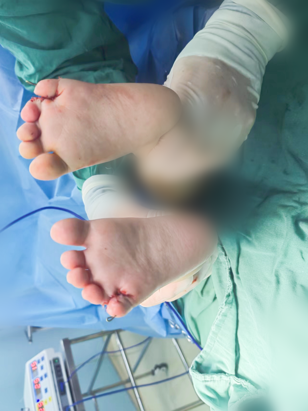 「我有多指,孩子没有,是亲生的吗」?医生回复了 6 个字!