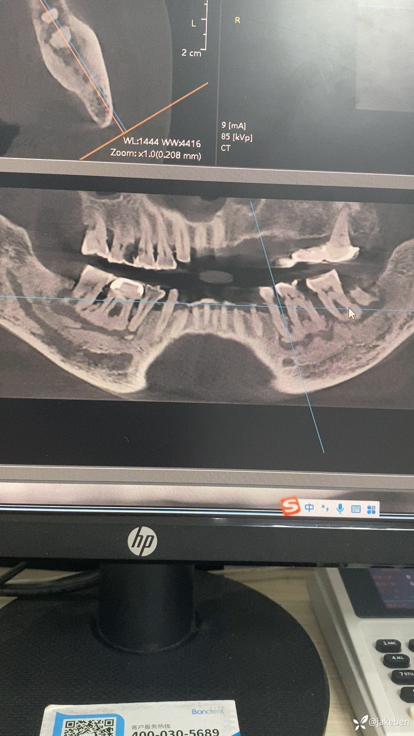 下颌骨ct图片