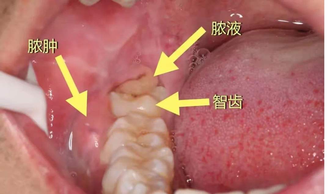 智齿冠周炎的那些事儿