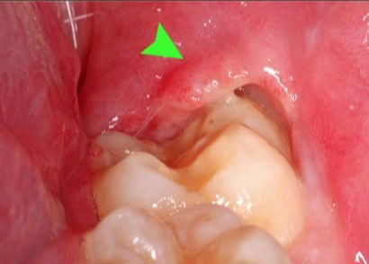 智齿冠周炎的那些事儿