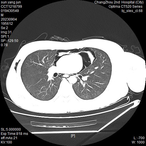 青少年剧烈运动后突发胸痛，检查竟是「纵隔气肿」！