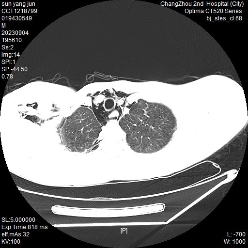青少年剧烈运动后突发胸痛，检查竟是「纵隔气肿」！