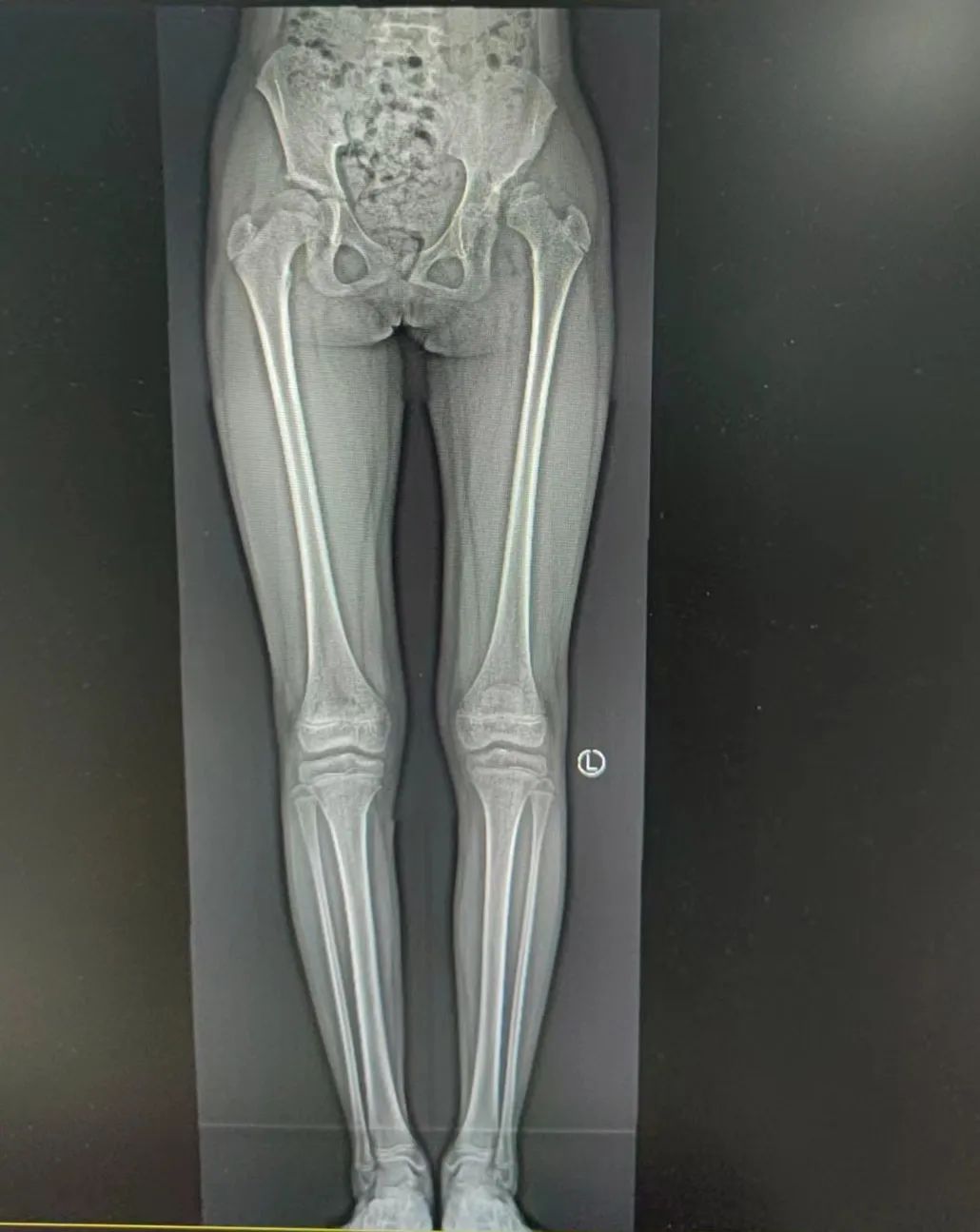 江西省儿童医院完成骨盆三联截骨术治疗大龄发育性髋关节脱位