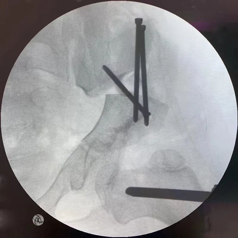 江西省儿童医院完成骨盆三联截骨术治疗大龄发育性髋关节脱位