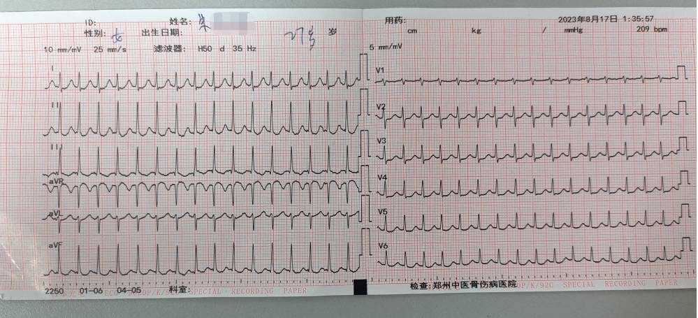 【急救时刻】心跳 206 次/分！仅用几个简单的动作，让失控心率恢复正常…
