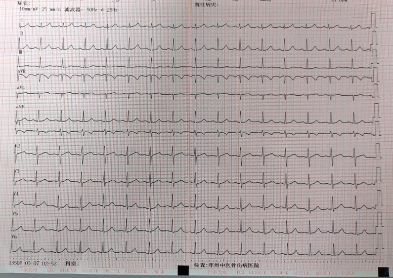【急救时刻】心跳 206 次/分！仅用几个简单的动作，让失控心率恢复正常…