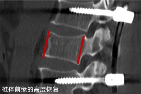 瑞康数智骨科，为腰椎骨折患者手术「撑腰」