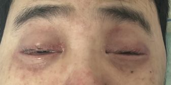 7 个小时，深圳市龙岗区人民医院这个医生团队将口水引到眼睛