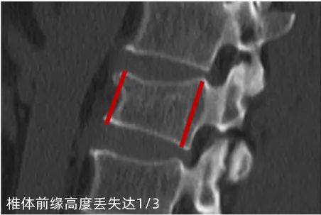 瑞康数智骨科，为腰椎骨折患者手术「撑腰」