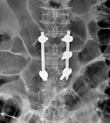 瑞康数智骨科，为腰椎骨折患者手术「撑腰」
