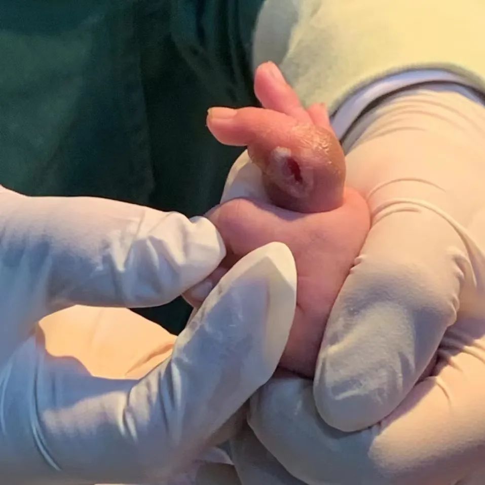 家长必看！宝宝手指红肿，元凶竟是它！