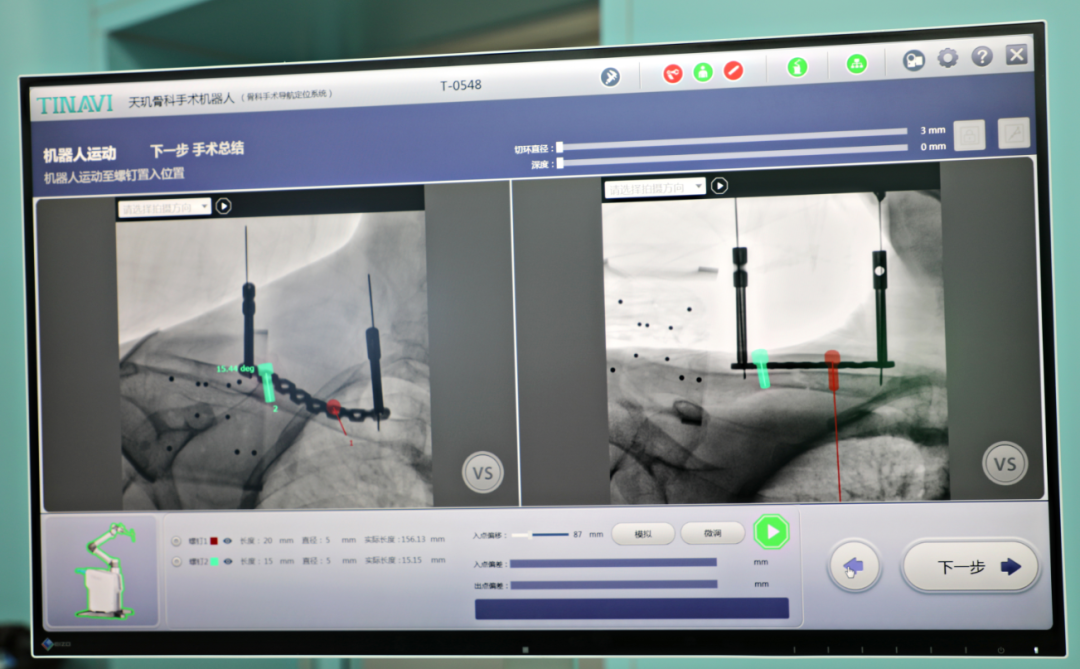 郑州仁济医院使用天玑机器人开展 2 台 5 G 远程骨科微创手术