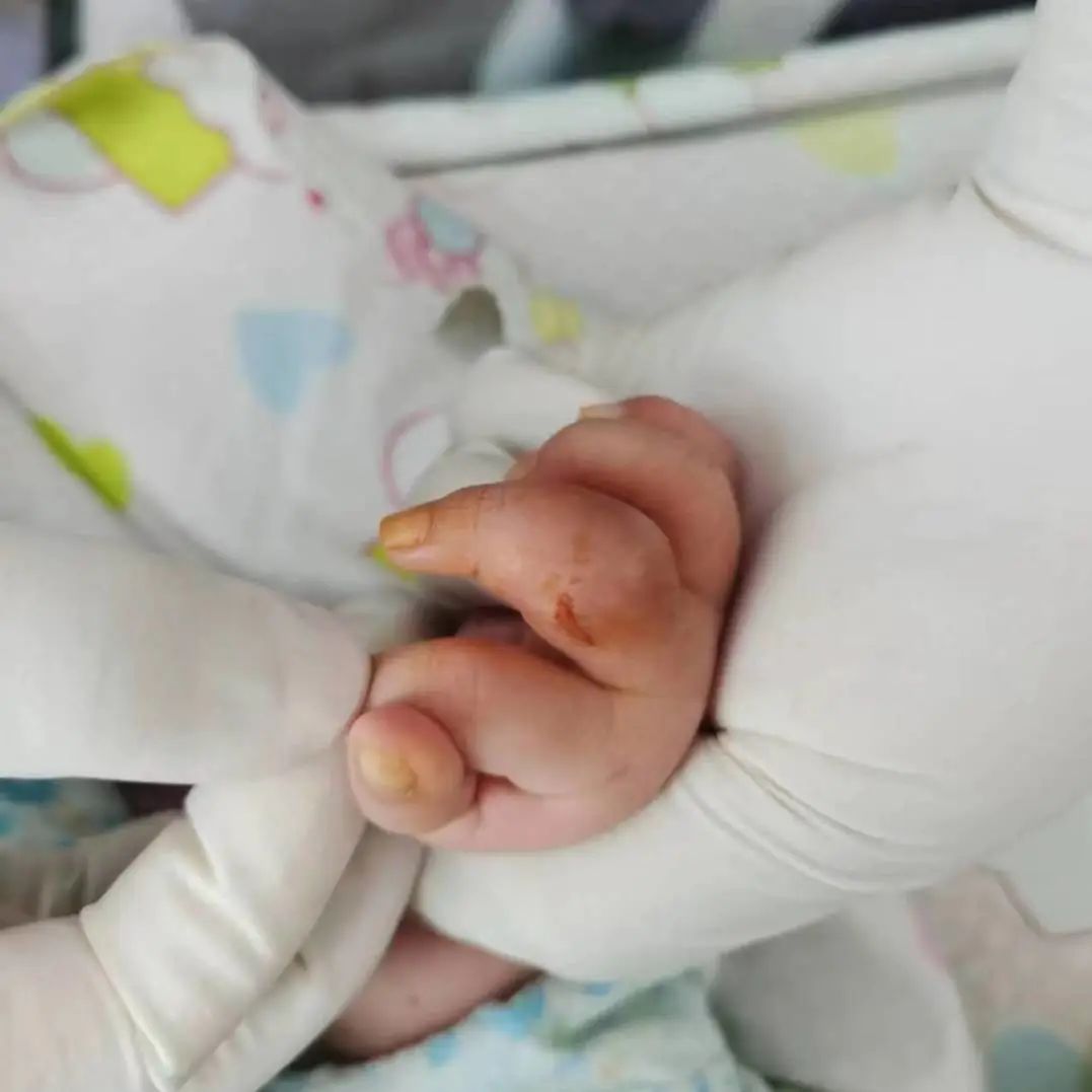 家长必看！宝宝手指红肿，元凶竟是它！