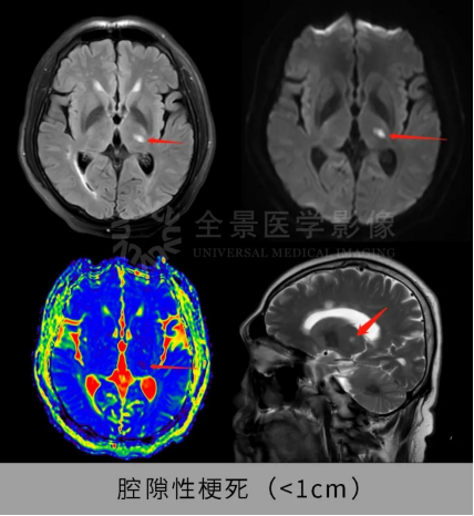 中国脑健康日：测一测，你离脑梗有多远？