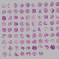 生存期鼻咽癌组织芯片