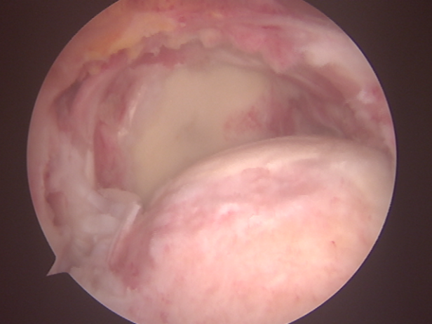 延安市中医医院（北京大学第三医院延安分院）运动医学科巧用微创技术治愈巨大肩袖撕裂患者