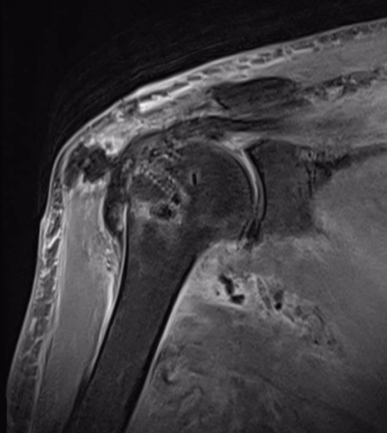 延安市中医医院（北京大学第三医院延安分院）运动医学科巧用微创技术治愈巨大肩袖撕裂患者