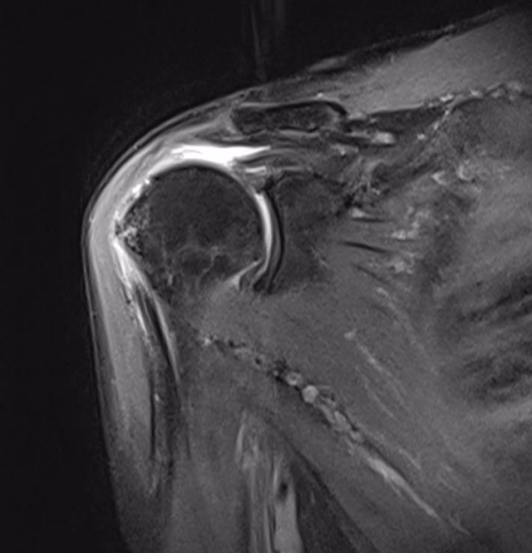 延安市中医医院（北京大学第三医院延安分院）运动医学科巧用微创技术治愈巨大肩袖撕裂患者