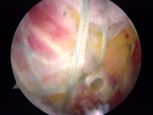 延安市中医医院（北京大学第三医院延安分院）运动医学科巧用微创技术治愈巨大肩袖撕裂患者