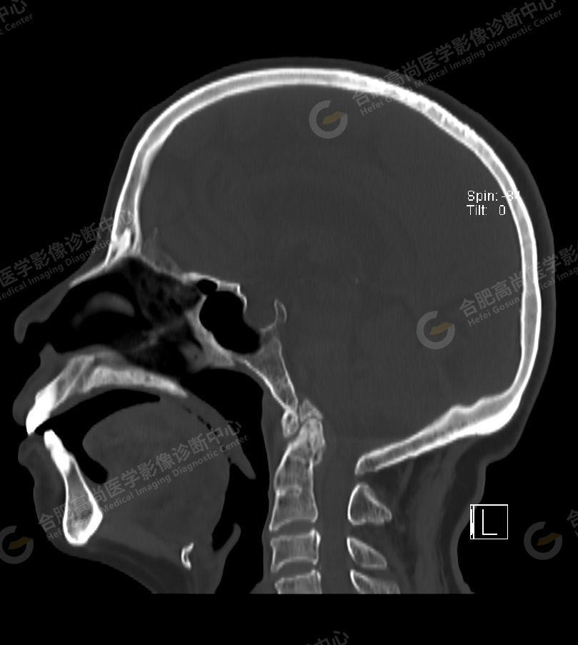 【高尚病例】术前检查头颅 CT 平扫发现「颅底凹陷症」1 例