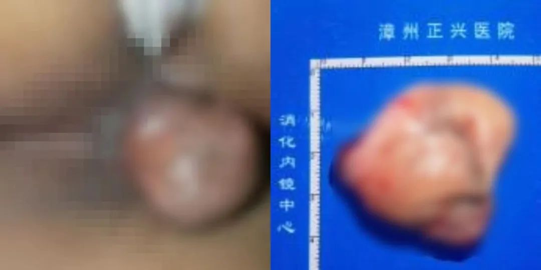 漳州正兴医院助力两名痔疮患者顺利完成除「痔」手术