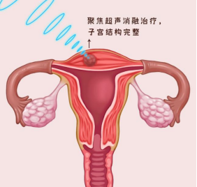 子宫肌瘤和腺肌症的差异，看完这一篇全懂了！