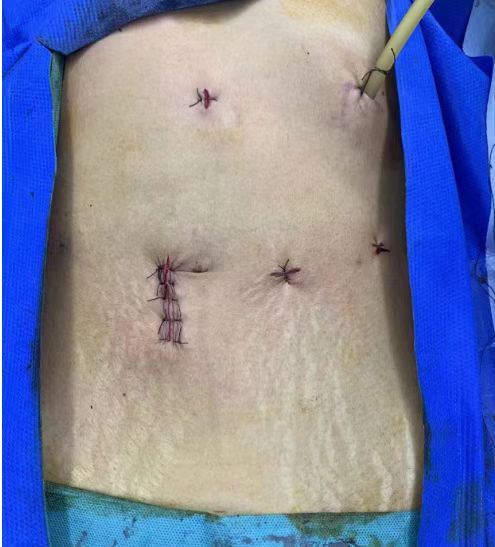 呕血至生命垂危？龙岗区人民医院成功为 51 岁女性切除巨大脾脏