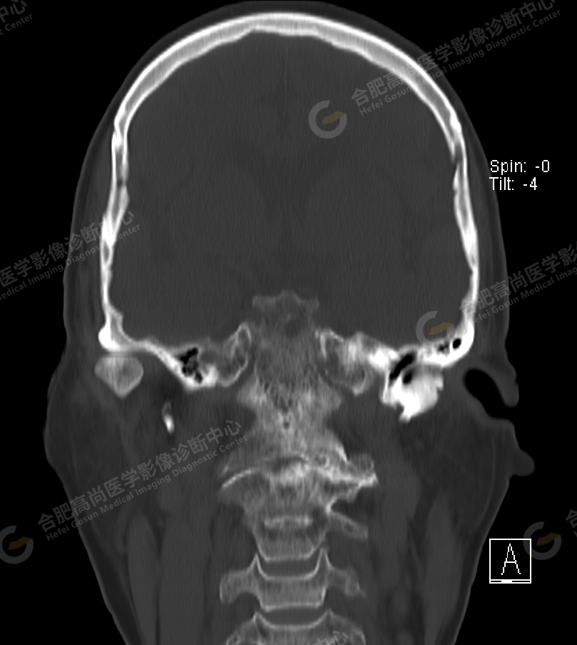【高尚病例】术前检查头颅 CT 平扫发现「颅底凹陷症」1 例