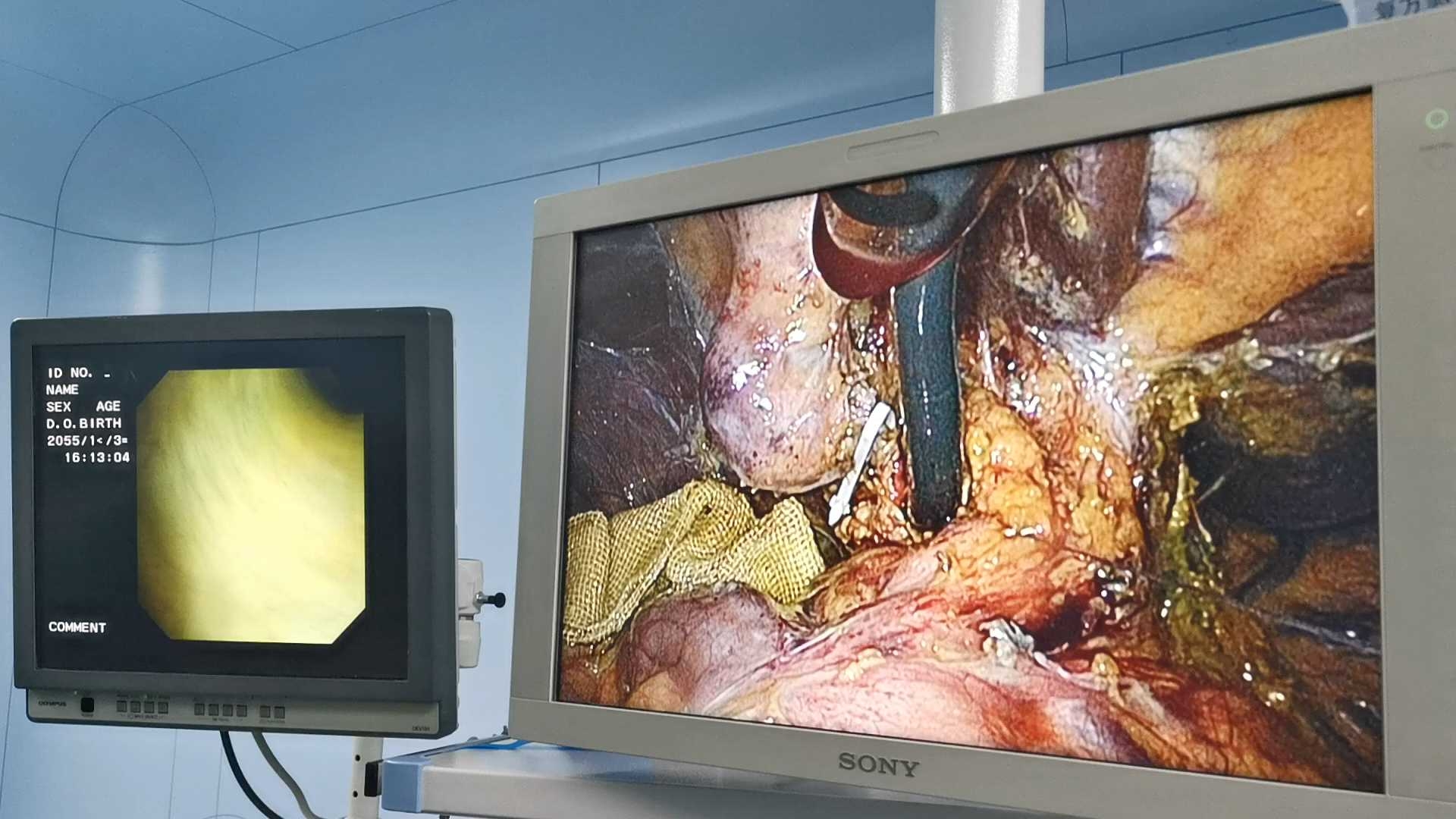 腹腔镜联合胆道镜经胆囊管取石难点系列三胆囊管扩张