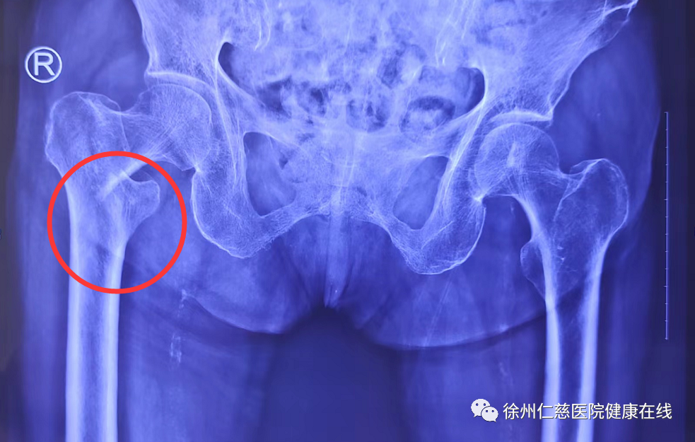 徐州仁慈医院助力百岁老人顺利完成髋关节置换手术