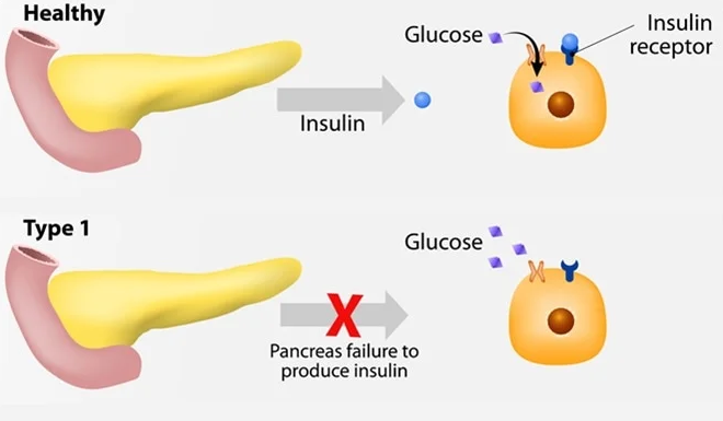 糖尿病治愈的突破口在哪里？由实战出发 — 1型糖尿病（DM）的造模方法速看！