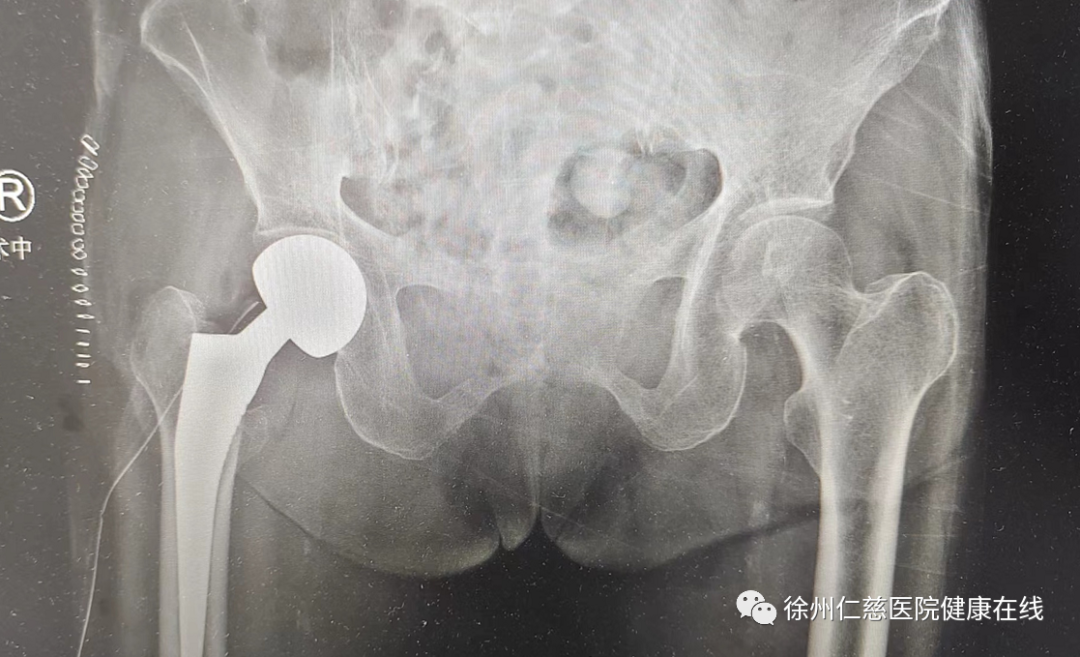 徐州仁慈医院助力百岁老人顺利完成髋关节置换手术