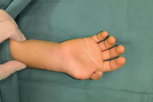 徐州仁慈医院助力拇指畸形患者重建手指