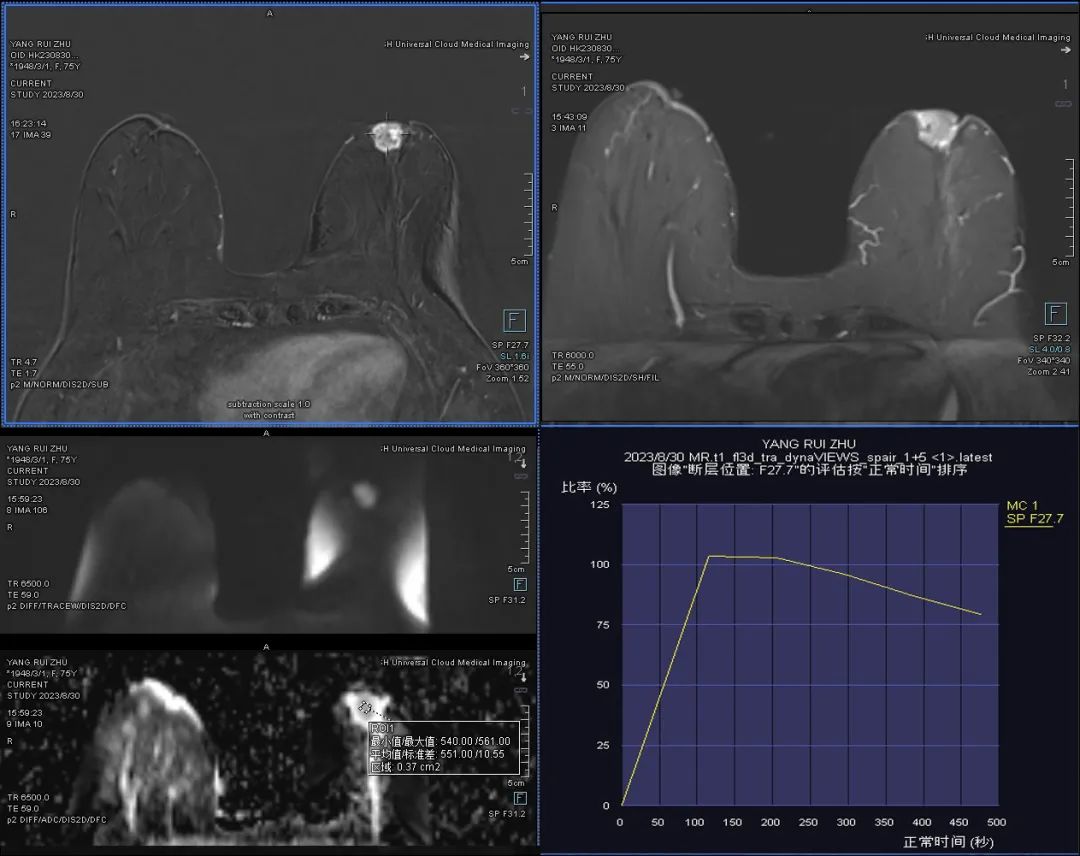 全景医学乳腺磁共振动态增强检查助力早期乳腺癌筛查诊断