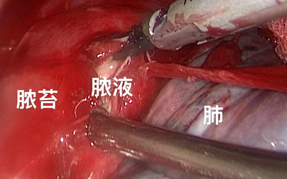 食道穿孔竟然是因为这！假期聚餐需注意