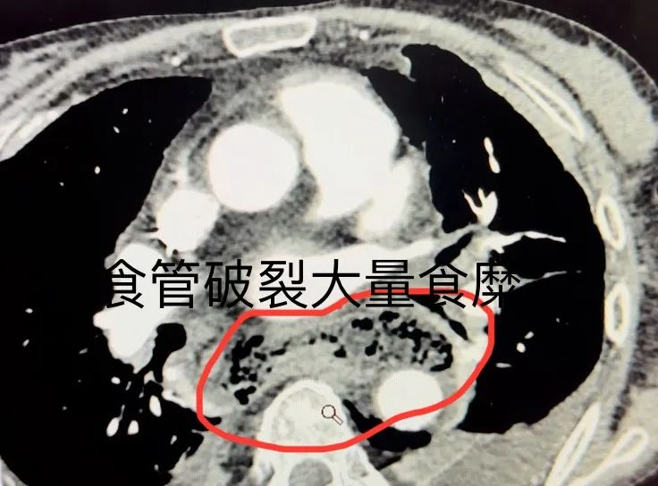 食道穿孔竟然是因为这！假期聚餐需注意