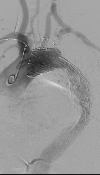 【重大突破】延大附院主动脉杂交手术再获成功