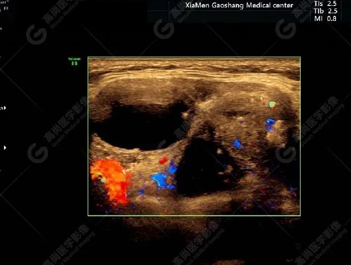 【超声病例】罕见甲状腺异位癌一例