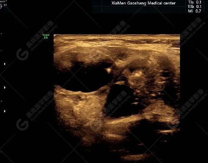 【超声病例】罕见甲状腺异位癌一例