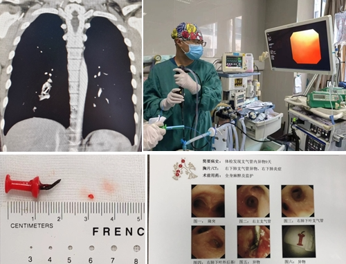 险！12 岁小孩支气管里竟取出一枚工字钉