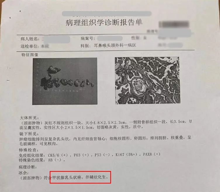 【超声病例】罕见甲状腺异位癌一例