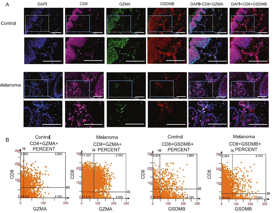 临床介导的 CD8+ T 细胞和 NK 细胞焦亡的发现揭示了黑色素瘤异质性