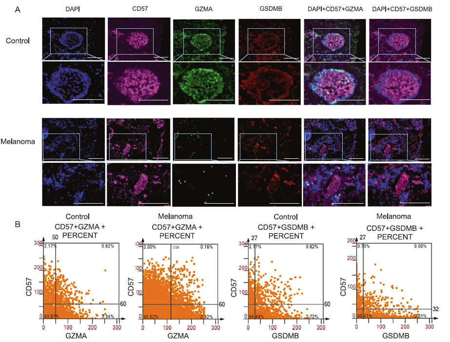 临床介导的 CD8+ T 细胞和 NK 细胞焦亡的发现揭示了黑色素瘤异质性