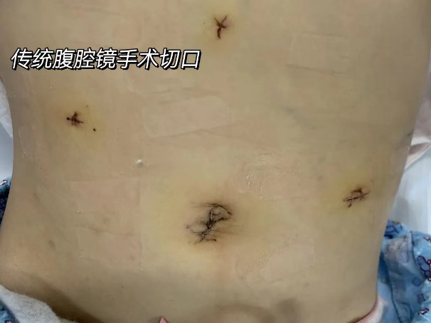 肚脐一个小切口,西安交通大学第一附属医院助花季少女成功脱去「小黄衣」