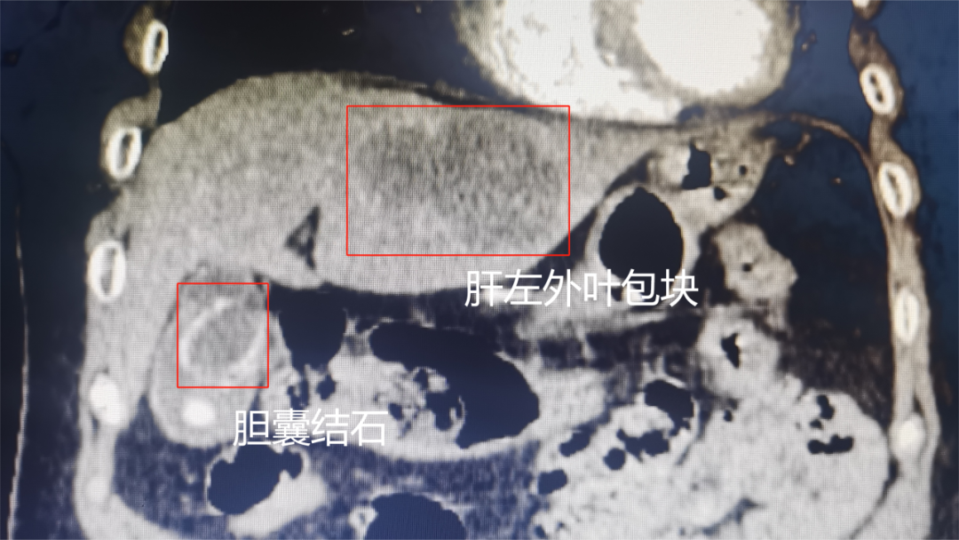 重庆松山医院肝胆外科开展经脐单孔腹腔镜肝左外叶+胆囊切除术