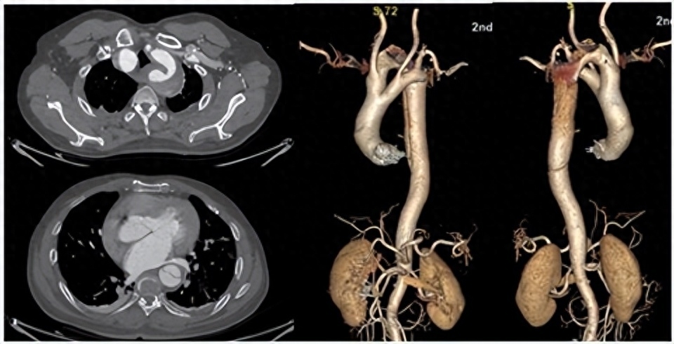 南昌大学二附院创新主动脉夹层治疗技术