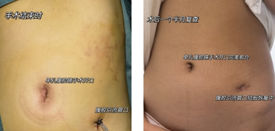 肚脐一个小切口,西安交通大学第一附属医院助花季少女成功脱去「小黄衣」